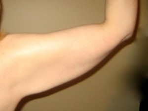 Patient arm before procedure